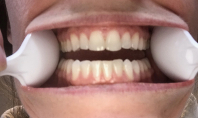 Edges of Teeth